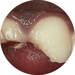 Restorative Dentistry - Dr. Rakesh Maini - crown and bridge